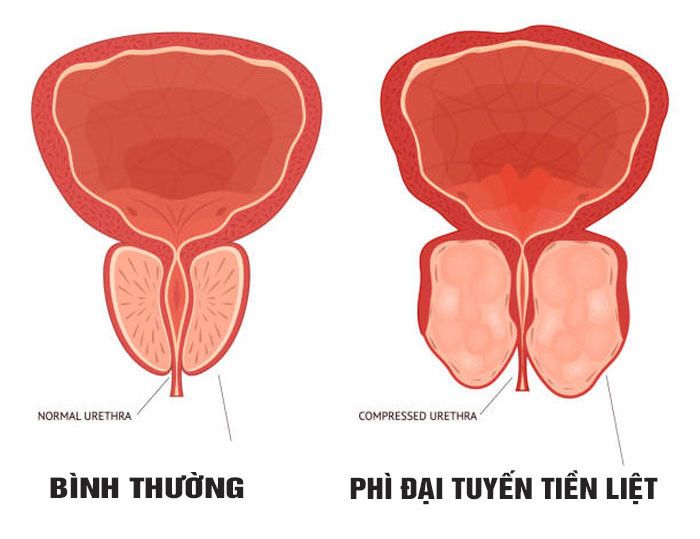 thảo dược chữa phì đại tiền liệt tuyến