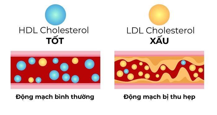 cholesterol bao nhiêu là cao