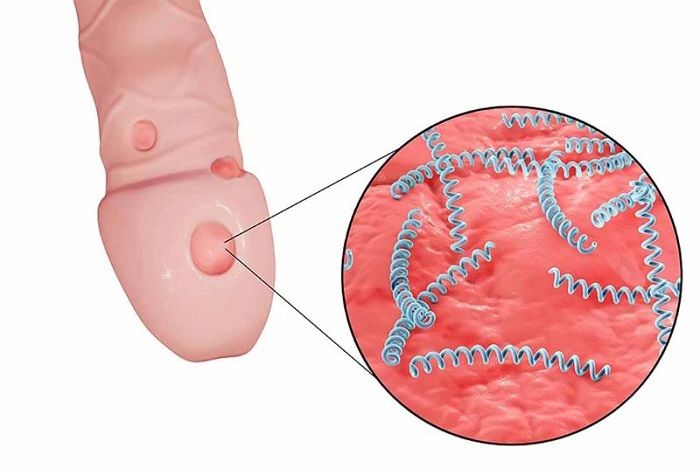 Giang mai ở dương vật