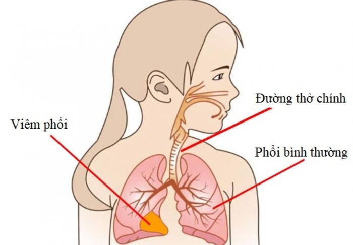 ho ở trẻ em