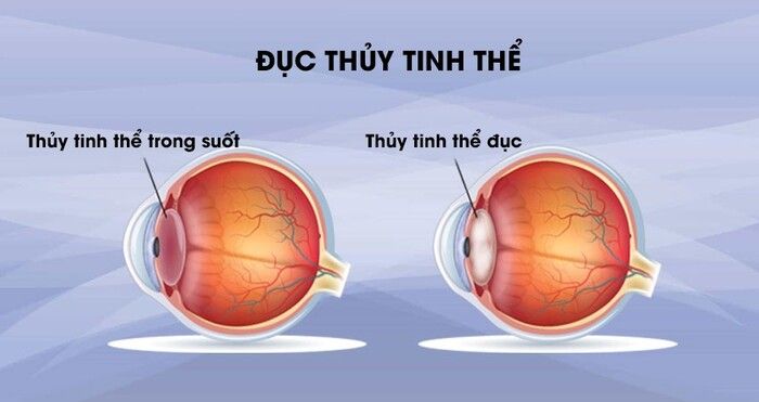 thuốc nhỏ mắt trị cườm khô